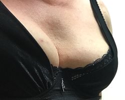 My hormone boobs