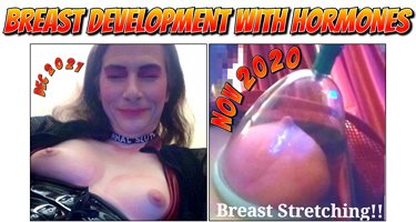 Breast development 2nd year of Hormones.