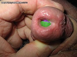 balloon in urethra