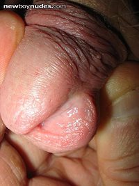 the cleft in my glans